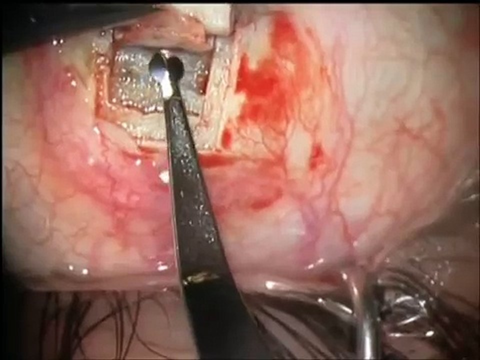 Deep sclerectomy