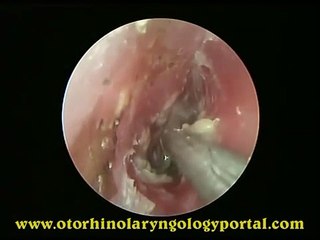 Suction Clearance of Superficial Fungal Infection of The Ear Canal (Otomycosis)