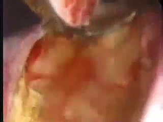 Transurethral Resection of the Prostate (TURP)