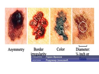 Melanom, najzloćudniji karcinom kože, 11. april 2015. (RTV Bor)