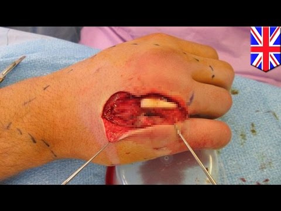 Teen finds brother’s entire tooth embedded in h...