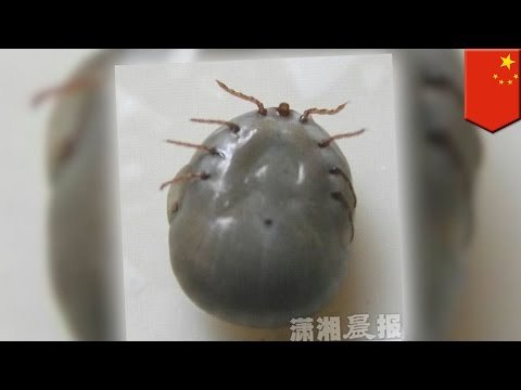 Tick removal: Tiny 2 year old has giant blood sucking tick, doctors help with removal - TomoNews