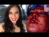 Police brutality: model sues transit cops for slamming her to the ground and breaking her face