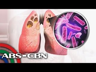 Higit 200,000 bagong kaso ng TB, naitala ng DOH