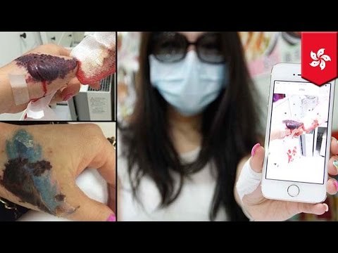Tattoo removal gone wrong: Hong Kong woman’s hand maimed by laser procedure