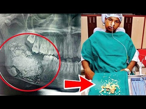 Indian boy Ashik Gavai has 232 teeth removed in JJ Hospital, Mumbai