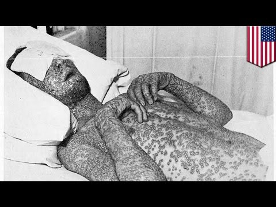 Not just smallpox: FDA finds more deadly viruses in National Institutes of Health lab, Maryland