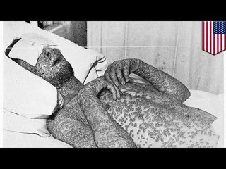 Not just smallpox: FDA finds more deadly viruses in National Institutes of Health lab, Maryland