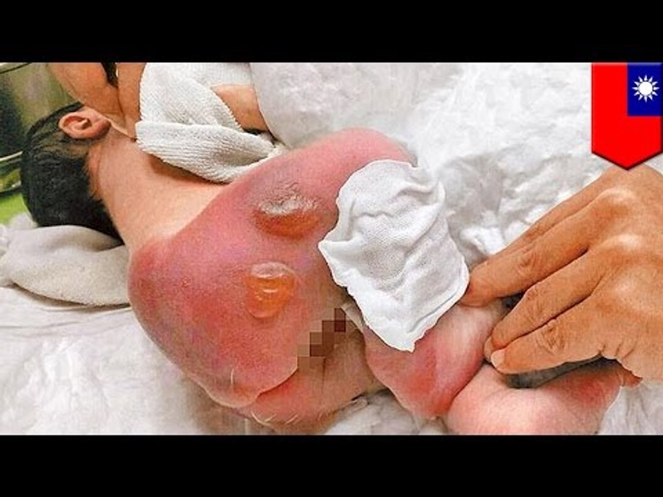 Baby burned in New Taipei City hospital: Careless nurse wraps newborn in electric blanket