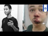 American teen Tariq Abu Khdeir brutally beaten by Israeli Police