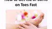 How to Get Rid of Corns on Toes Fast