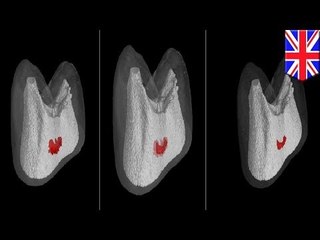 Self-healing teeth? UK scientists develop new pain-free cavity treatment
