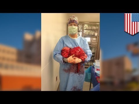 Doctors remove 47 pound tumor from Arizona woman's stomach, similar case in Georgia