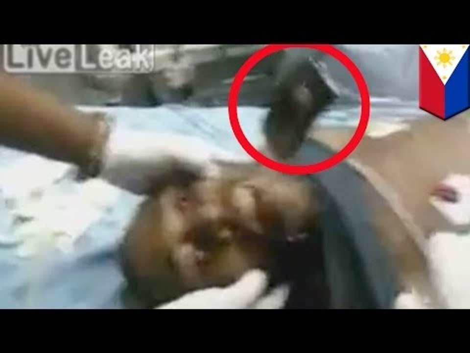Bizarre things discovered in the human body: cellphone found in a man's throat