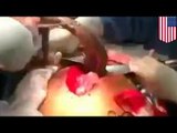 Operacja: lekarze usuwają rybę z anusa mężczyzny