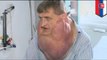 Slovakian man Stefan Zoleik thrilled after 6 kilo tumor removed from his face