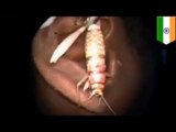 Lekarze wyjmują wielkiego robaka z ucha mężczyzny.