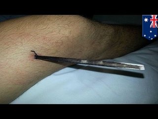 Atak płaszczki: kolec utkwił w nodze na 24 godziny.