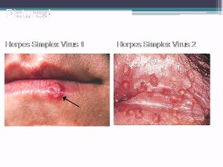 ultimate-herpes-protocol-review