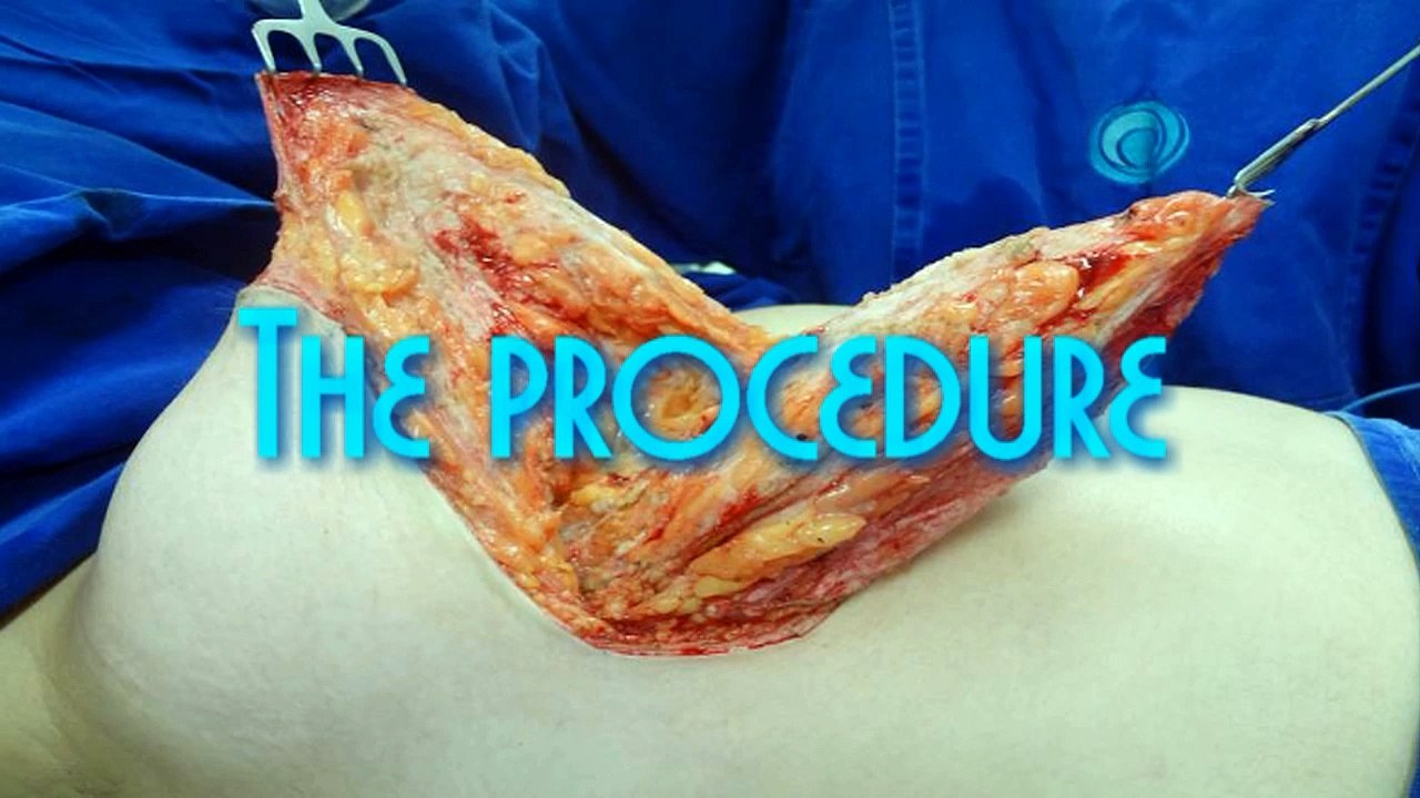 VERTICAL MASTOPEXY by Ruth GRAF - Brazil