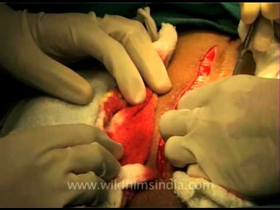 Abdominal surgery