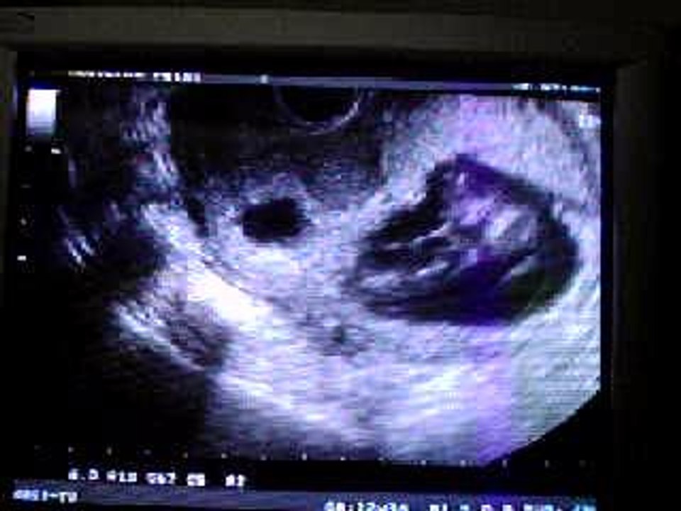 Ecografía semana 12