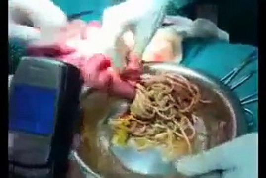 Operation intestinal worms Ascariasis bolus‬‏