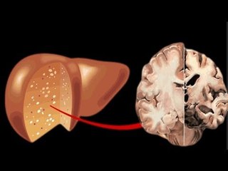 Fatty liver starves brain of an essential protein, leading to dementia