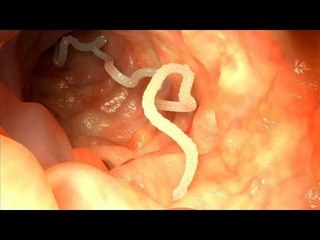 Woman swallows tapeworm to lose weight, it doesn't go well