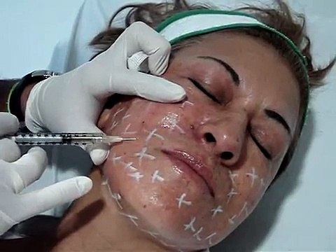 PLASMA RICO EN PLAQUETAS