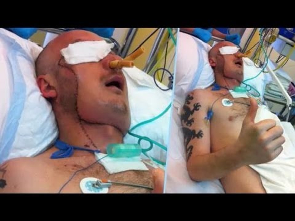 顔面に皮膚移植　第二の人生