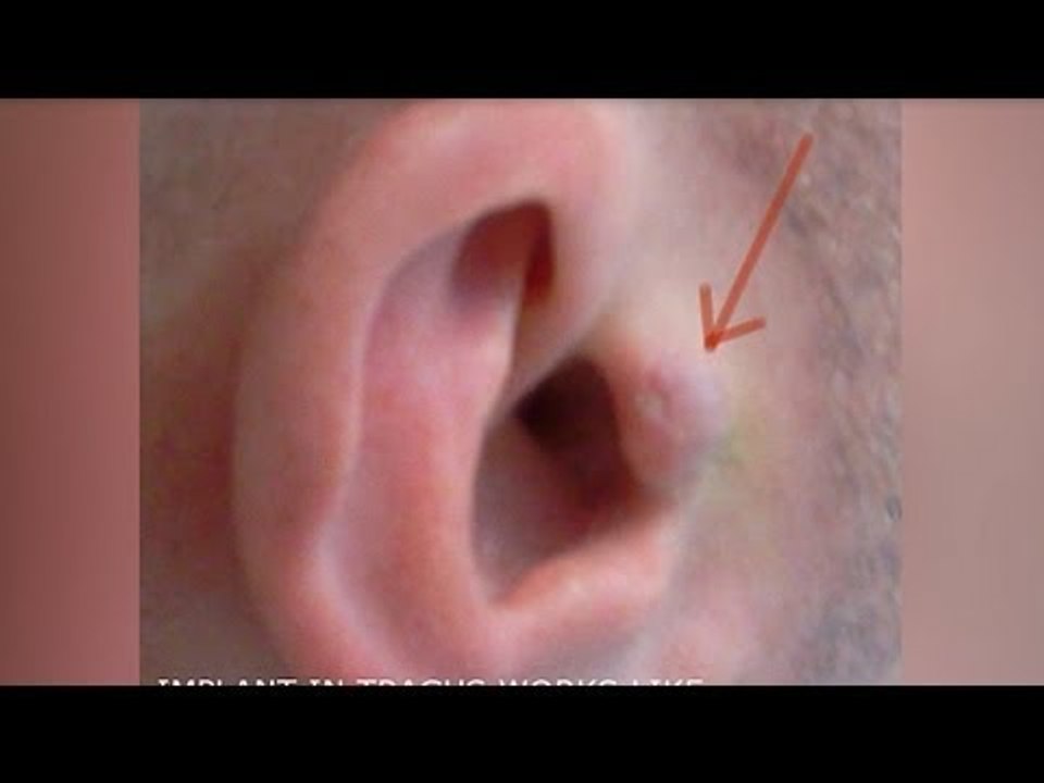Man implants 'invisible headphones' in ears