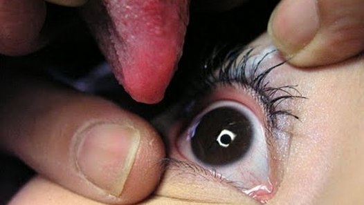 SUPER GROSS: Japanese eyeball licking sees spread of eye chlamydia