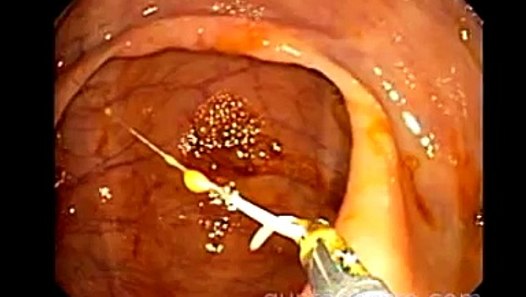 Live "Whip WORM" inside the human body- Colonoscopy in New York ( whip