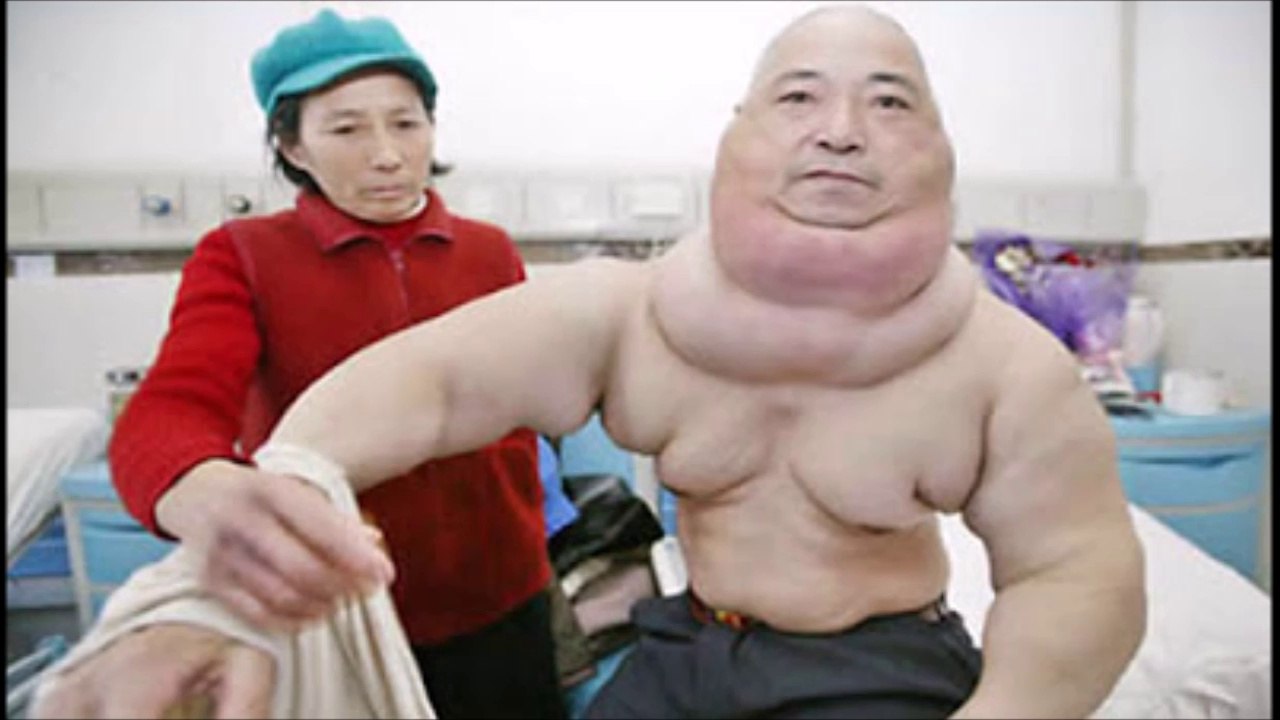 Unbelievable Human Malformations - Scary Compilation