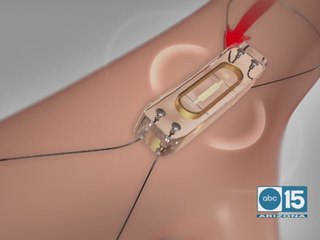 Learn about new heart failure management options