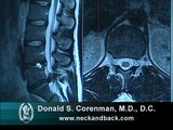 How to Read a MRI of a Lumbar Herniated Disc | Lower Back Pain | Colorado Spine Surgeon