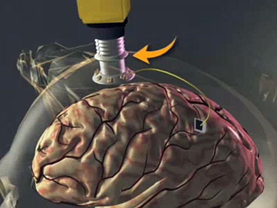 Telepathic Technology [BrainGate]