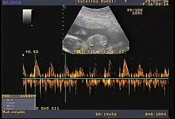 Ecografia de J, 4 meses