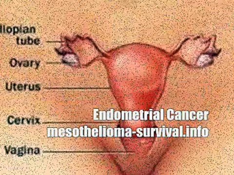 Endometrial Cancer: Endometrial Cancer Is Treatable