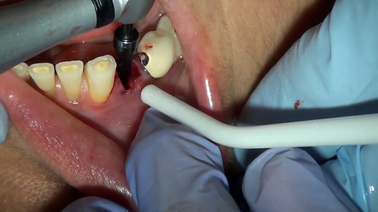 Dental Implant