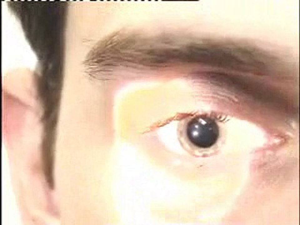 abnormal pupil examination