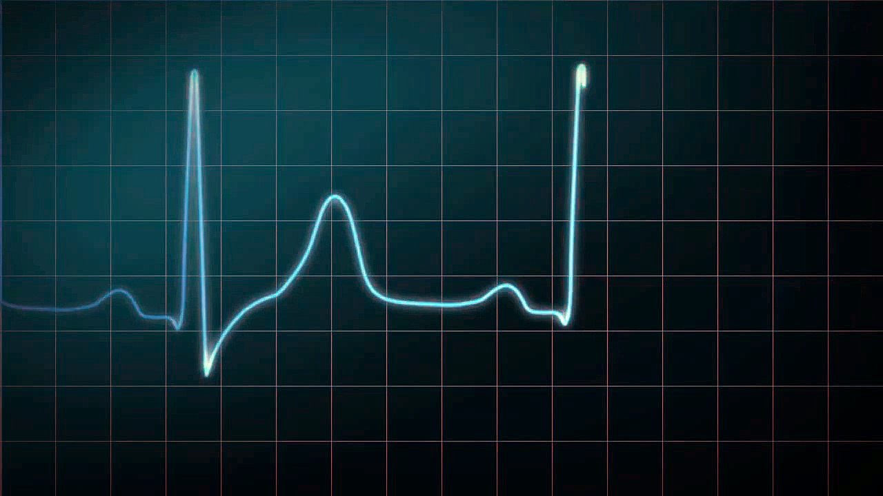 048 How to Read an Electrocardiogram (ECG/EKG)