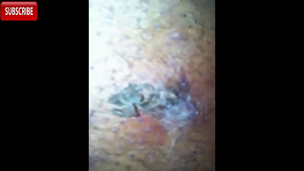 Huge Neverending Blackhead