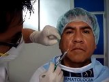 Tratamiento antiarrugas, relleno de arrugas con acido hialuronico, eliminar arrugas Lima Perú (1/2)