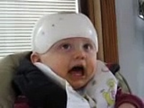 benign paroxysmal tonic upgaze disorder