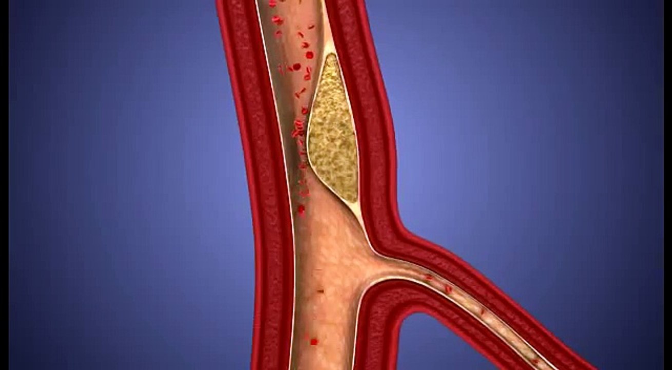 Atherosclerosis - 3D Animation || ABP ©