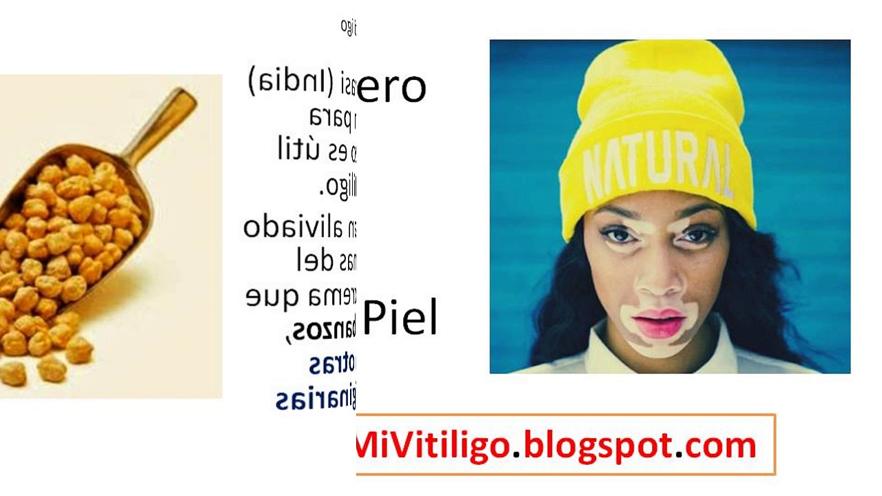 Como Se Cura El Vitiligo con Tratamiento Natural