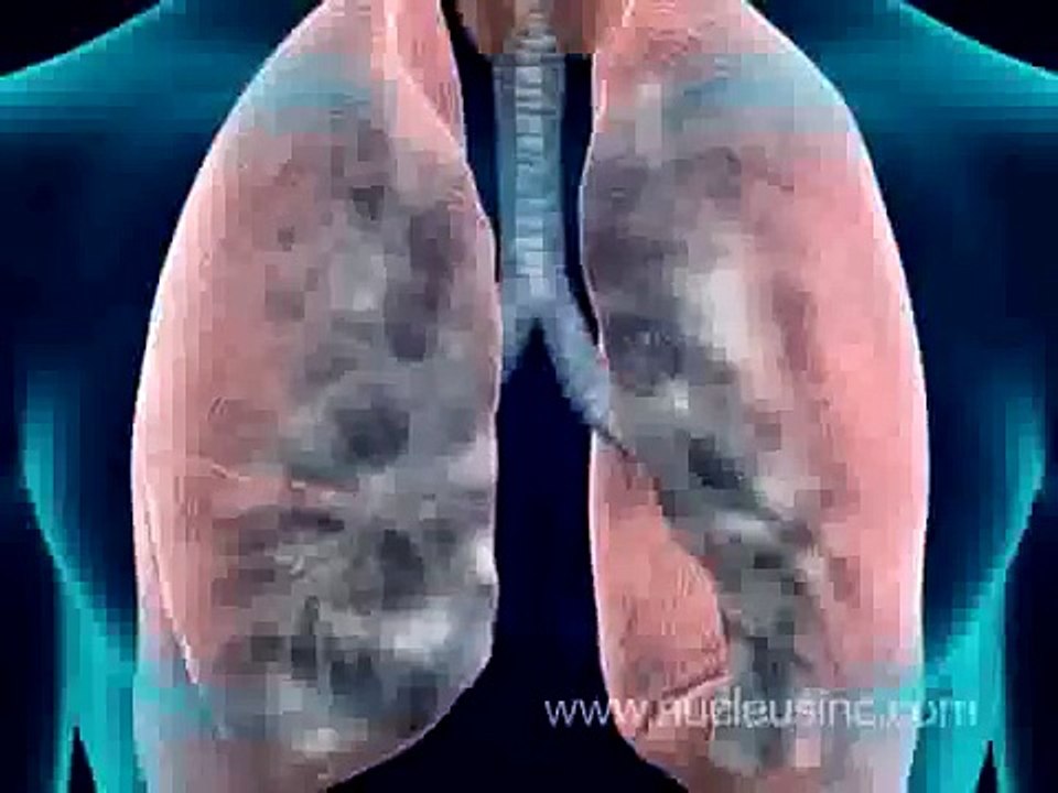 _ Smoking Causes Emphysema