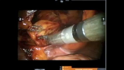 Robotic Bilateral Inguinal Hernia Repair